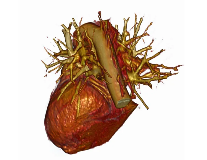 Framed Print : 3D CT Scan of Heart Framed Print : 3D CT Scan of Heart