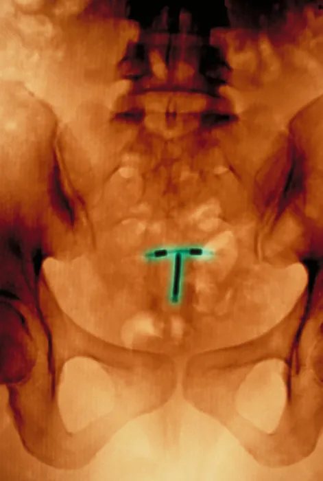 Framed Print : Abdomen x-ray Framed Print : Abdomen x-ray
