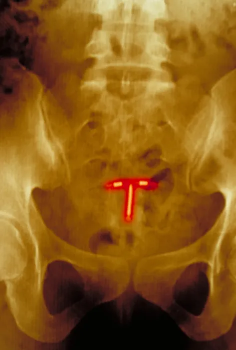 Framed Print : Abdomen x-ray Framed Print : Abdomen x-ray