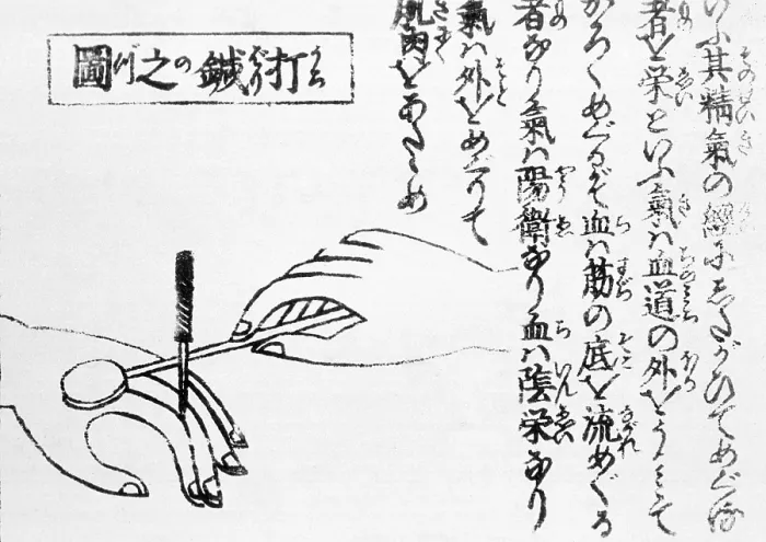 Framed Print : Acupuncture, Moxa Treatment, 1718