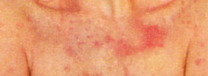 Framed Print : Acute Psoriasis on teh chest of a female patient, autoimmune disease, skin condition Framed Print : Acute Psoriasis on teh chest of a female patient, autoimmune disease, skin condition