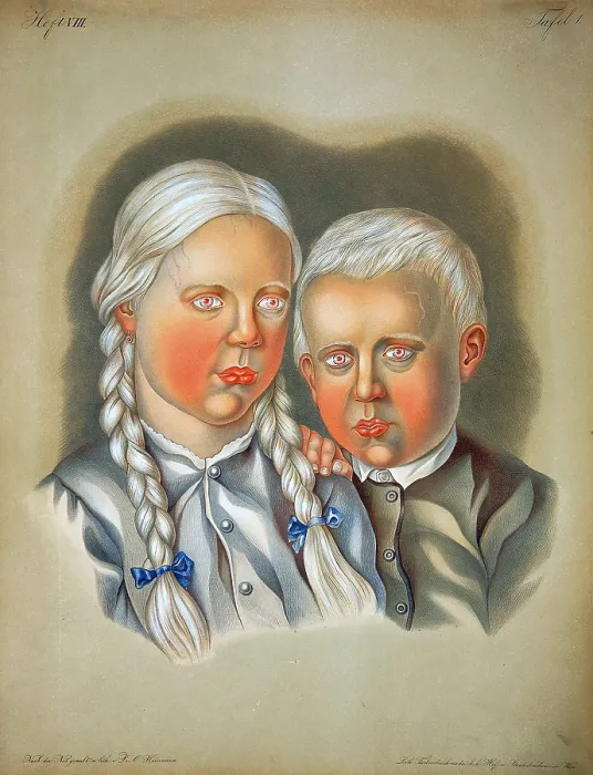 Framed Print : Albino Children, 19th Century Framed Print : Albino Children, 19th Century