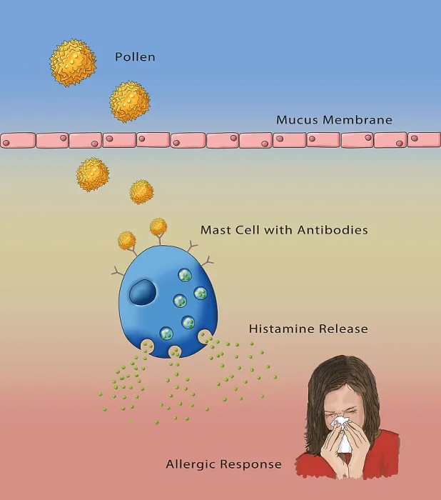 Framed Print : Allergic Response, Illustration Framed Print : Allergic Response, Illustration
