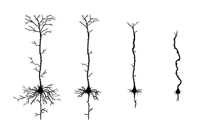Framed Print : Alzheimer's Disease, Neuron Degeneration Framed Print : Alzheimer's Disease, Neuron Degeneration