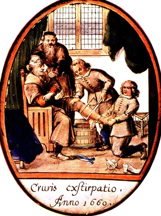 Framed Print : Amputation, 1660 Framed Print : Amputation, 1660