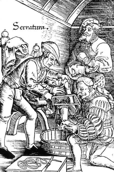 Framed Print : Amputation, 16th Century Framed Print : Amputation, 16th Century