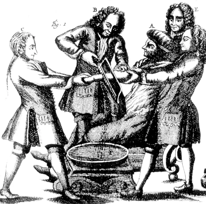 Framed Print : Amputation, 1719 Framed Print : Amputation, 1719