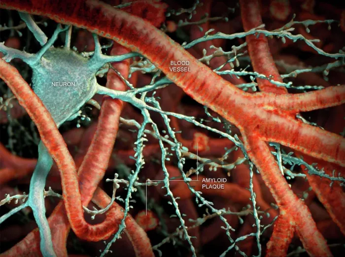 Framed Print : Amyloid Plaque