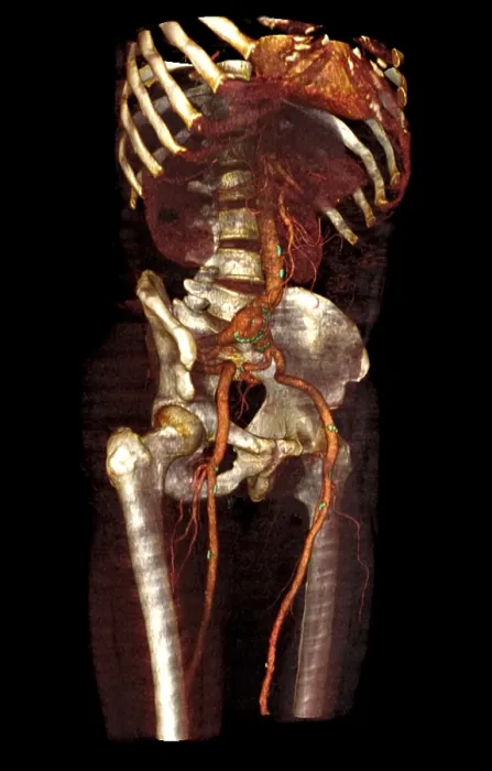 Framed Print : Aneurysm. Lower limb angio CT of a patient with atherosclerotic changes Framed Print : Aneurysm. Lower limb angio CT of a patient with atherosclerotic changes
