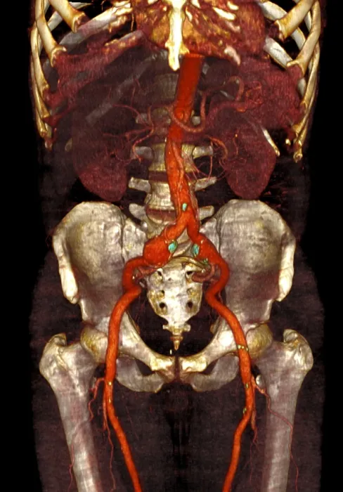 Framed Print : Aneurysm. Three views of a lower limb angio CT of a patient with atherosclerotic