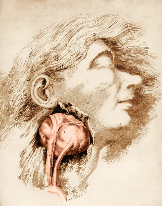 Framed Print : Aneurysm of the Carotid Artery