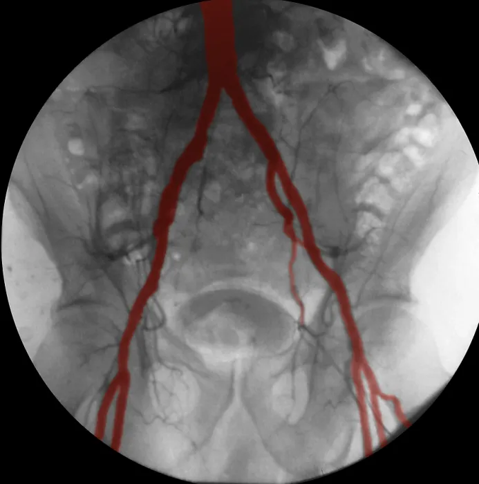 Framed Print : Angiogram of Iliac Arteries