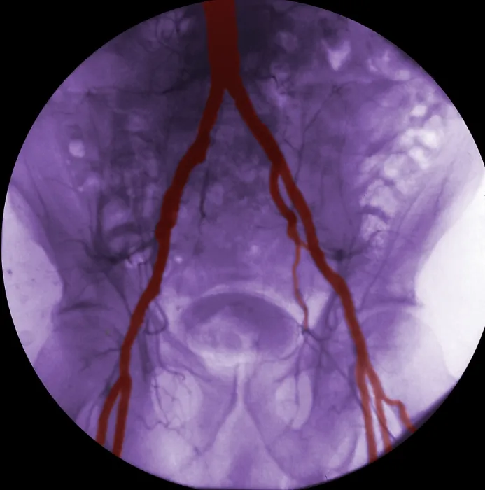 Framed Print : Angiogram of Iliac Arteries