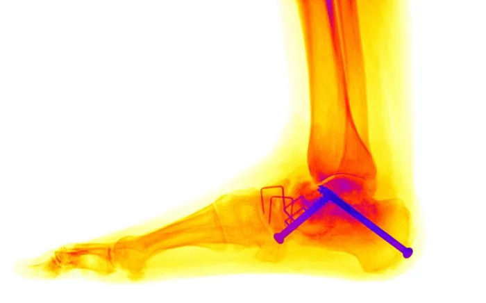 Framed Print : Ankle Fracture Framed Print : Ankle Fracture
