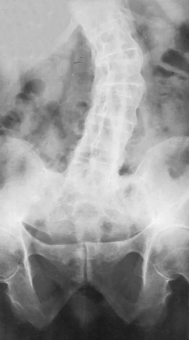 Framed Print : Ankylosing Spondylitis, X-Ray Framed Print : Ankylosing Spondylitis, X-Ray