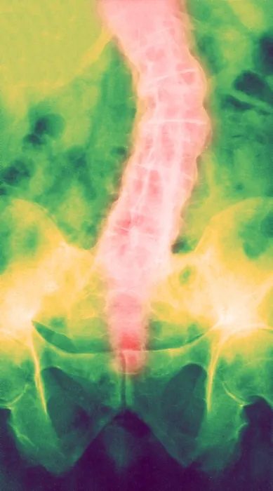 Framed Print : Ankylosing Spondylitis, X-Ray Framed Print : Ankylosing Spondylitis, X-Ray