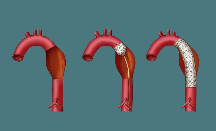 Framed Print : Aortic Aneurysm Stent, Illustration Framed Print : Aortic Aneurysm Stent, Illustration