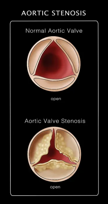 Framed Print : Aortic Valve, Normal & Stenosis, Illustration