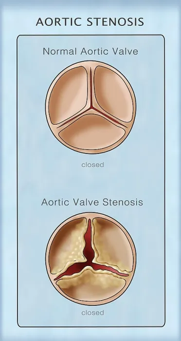 Framed Print : Aortic Valve, Normal & Stenosis, Illustration