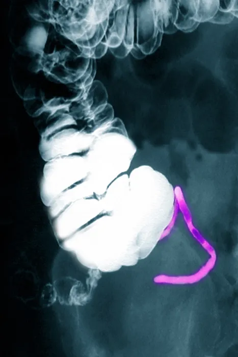 Framed Print : Appendix x-ray with barium contrast Framed Print : Appendix x-ray with barium contrast