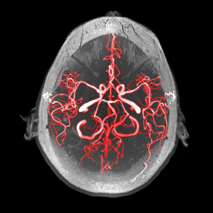 Framed Print : Arteries of the Brain, MRA
