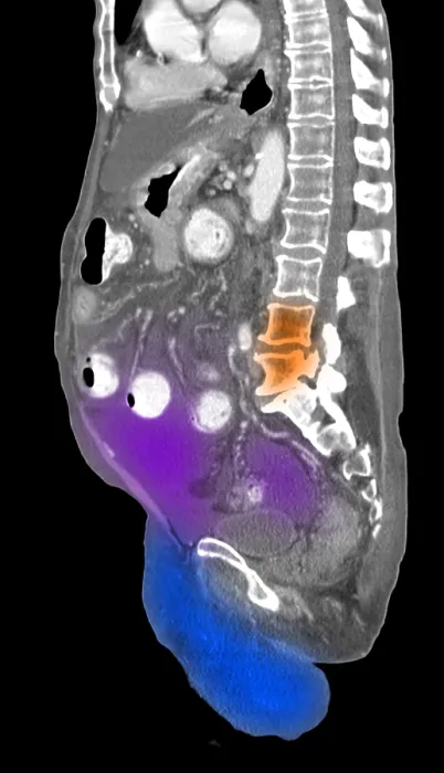 Framed Print : Ascites Fluid in Abdomen, CT Scan Framed Print : Ascites Fluid in Abdomen, CT Scan