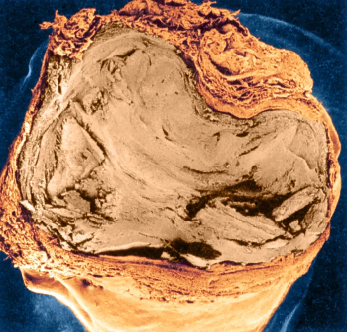 Framed Print : Atherosclerosis SEM, full blockage Framed Print : Atherosclerosis SEM, full blockage