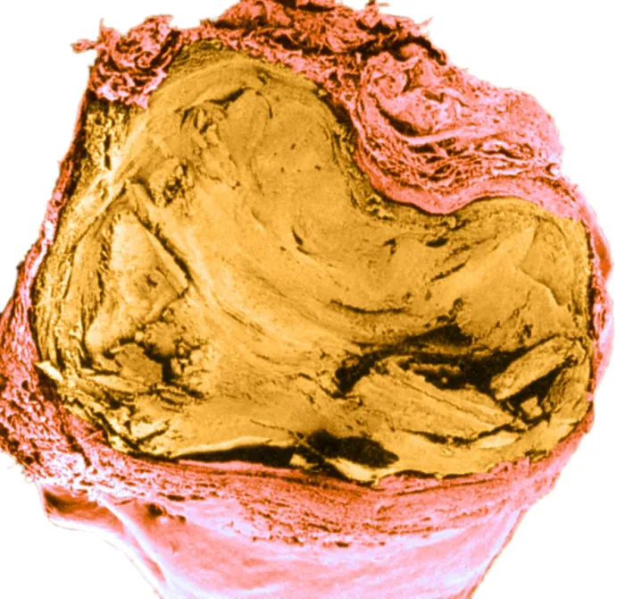 Framed Print : Atherosclerosis SEM, full blockage Framed Print : Atherosclerosis SEM, full blockage