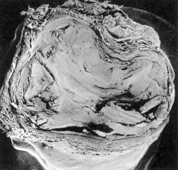 Framed Print : Atherosclerosis SEM, full blockage Framed Print : Atherosclerosis SEM, full blockage