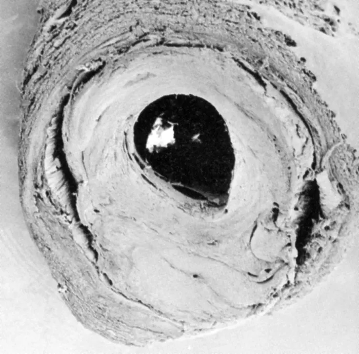 Framed Print : Atherosclerosis SEM, partial blockage Framed Print : Atherosclerosis SEM, partial blockage