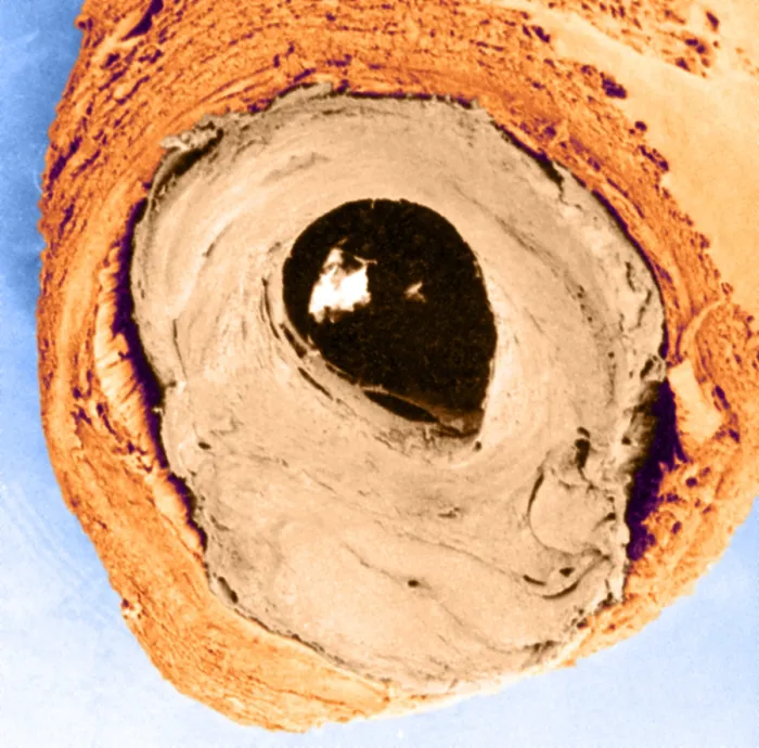Framed Print : Atherosclerosis SEM, partial blockage Framed Print : Atherosclerosis SEM, partial blockage