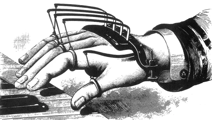 Framed Print : Atkins Finger-Supporting Device, 1881 Framed Print : Atkins Finger-Supporting Device, 1881