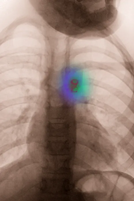 Framed Print : Atrial Septal Defect Treatment