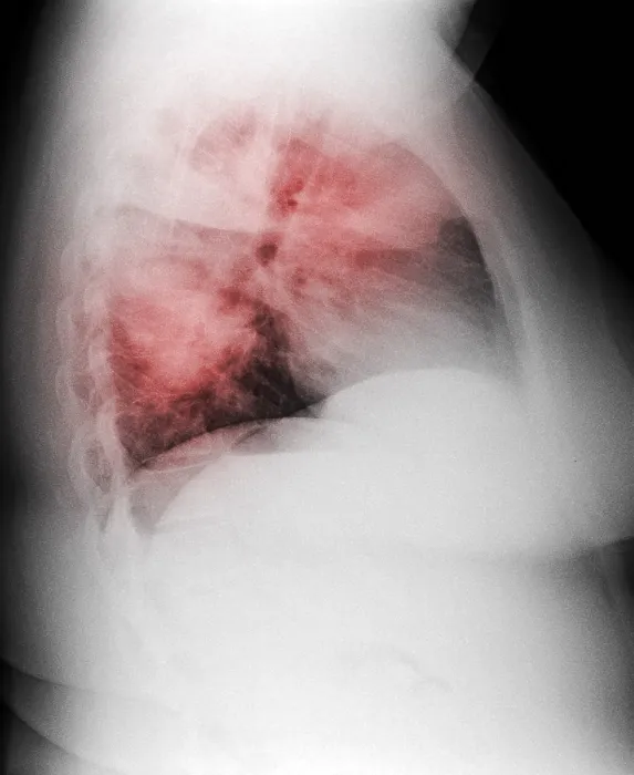 Framed Print : Atypical Pneumonia in Smoker, X-ray Framed Print : Atypical Pneumonia in Smoker, X-ray