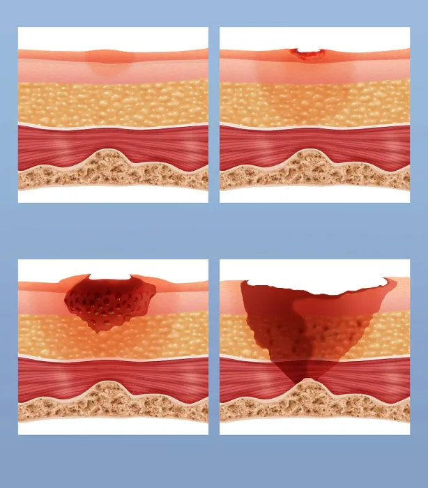 Framed Print : Bed Sores. Illustration showing the stages of of a bed sore or pressure ulcer Framed Print : Bed Sores. Illustration showing the stages of of a bed sore or pressure ulcer