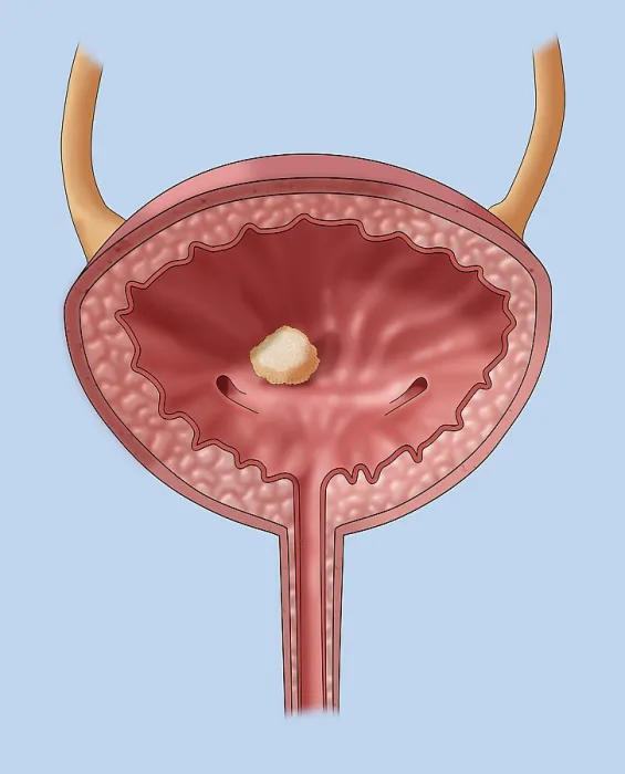 Framed Print : Bladder Stone, Illustration
