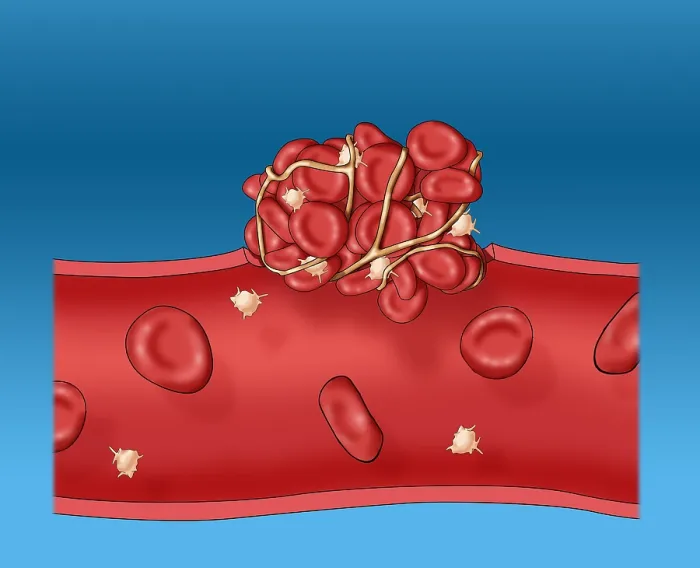 Framed Print : Blood clot