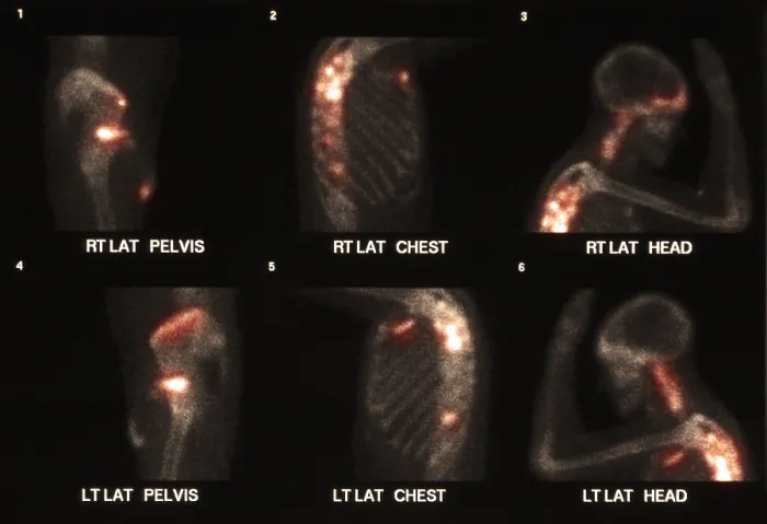 Framed Print : Bone scan showing multiple metastases Framed Print : Bone scan showing multiple metastases