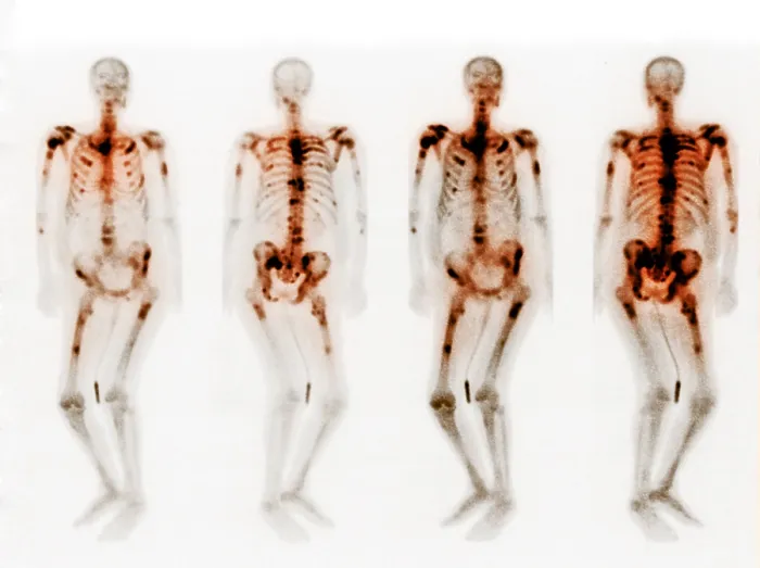 Framed Print : Bone scan showing multiple metastases Framed Print : Bone scan showing multiple metastases