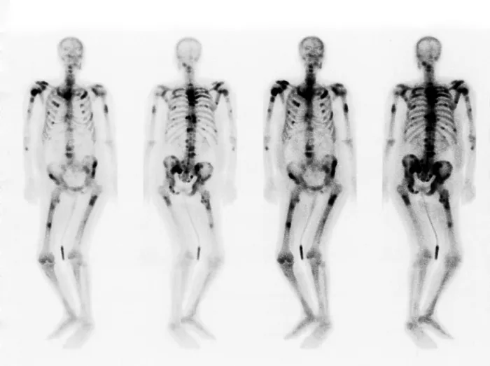 Framed Print : Bone scan showing multiple metastases Framed Print : Bone scan showing multiple metastases