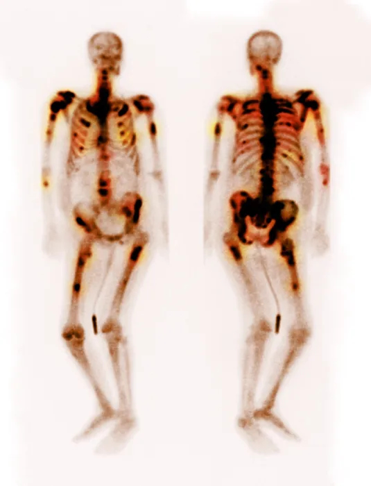 Framed Print : Bone scan showing multiple metastases Framed Print : Bone scan showing multiple metastases