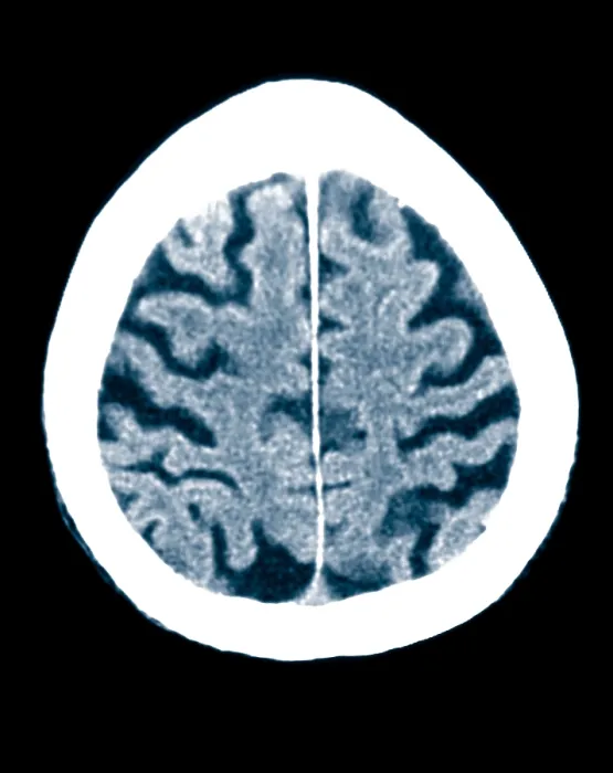 Framed Print : Brain of Alzheimer's Patient, CT Scan Framed Print : Brain of Alzheimer's Patient, CT Scan