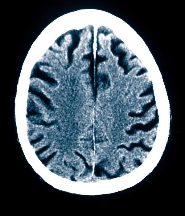 Framed Print : Brain of Alzheimer's Patient, CT Scan Framed Print : Brain of Alzheimer's Patient, CT Scan