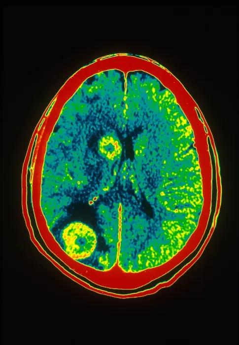 Framed Print : Brain Cancer, CT Scan
