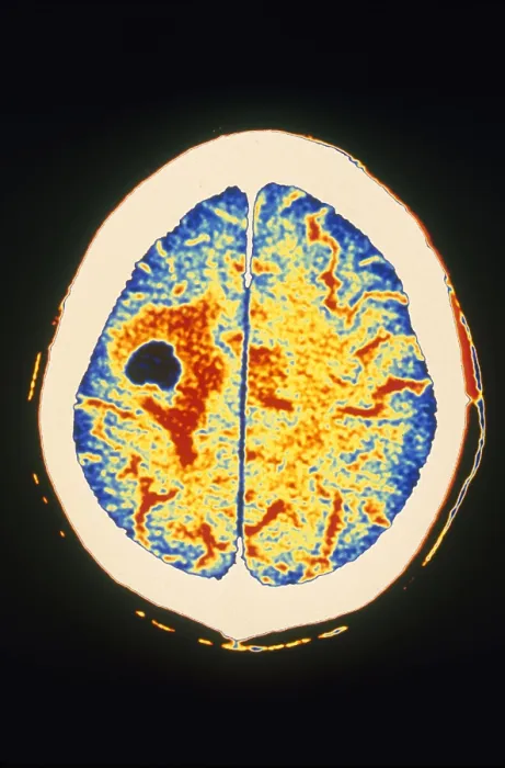 Framed Print : Brain Cancer & Edema, CT Scan Framed Print : Brain Cancer & Edema, CT Scan