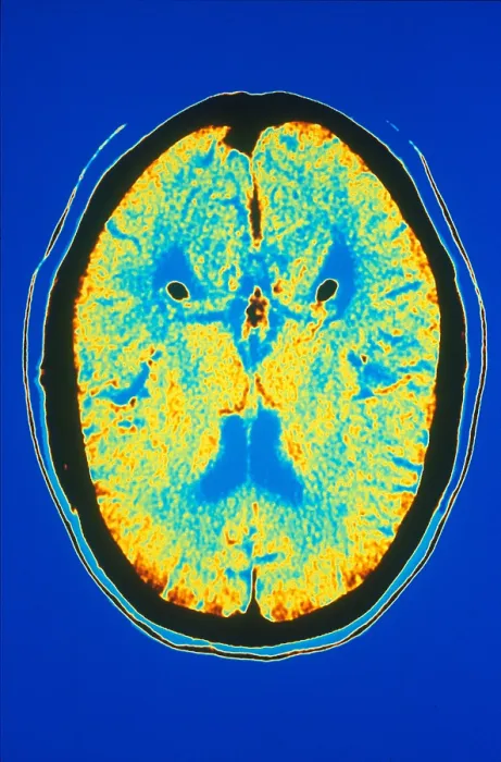 Framed Print : Brain, CT Scan Framed Print : Brain, CT Scan