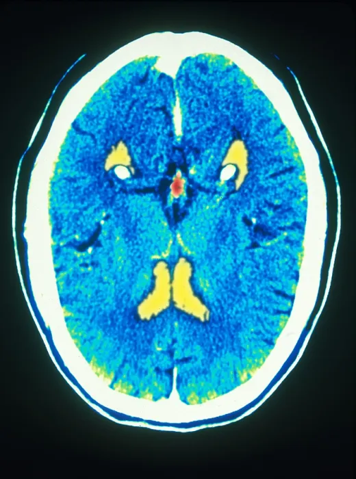 Framed Print : Brain, CT Scan