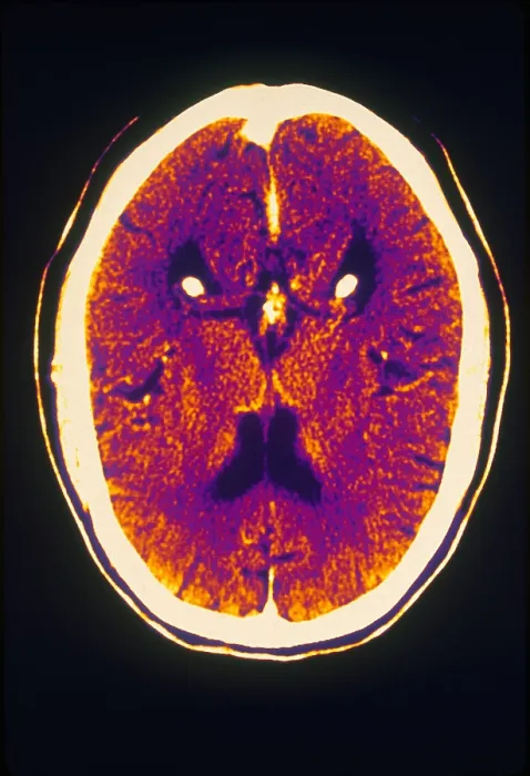 Framed Print : Brain, CT Scan Framed Print : Brain, CT Scan
