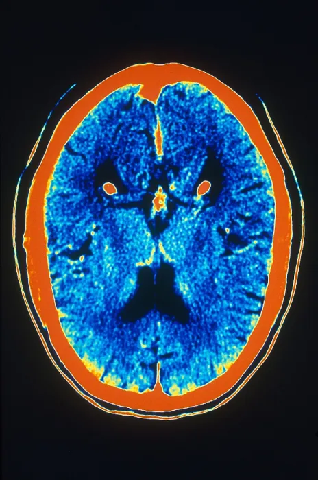 Framed Print : Brain, CT Scan Framed Print : Brain, CT Scan