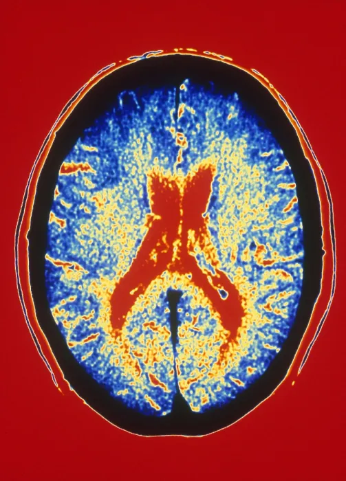 Framed Print : Brain, CT Scan Framed Print : Brain, CT Scan